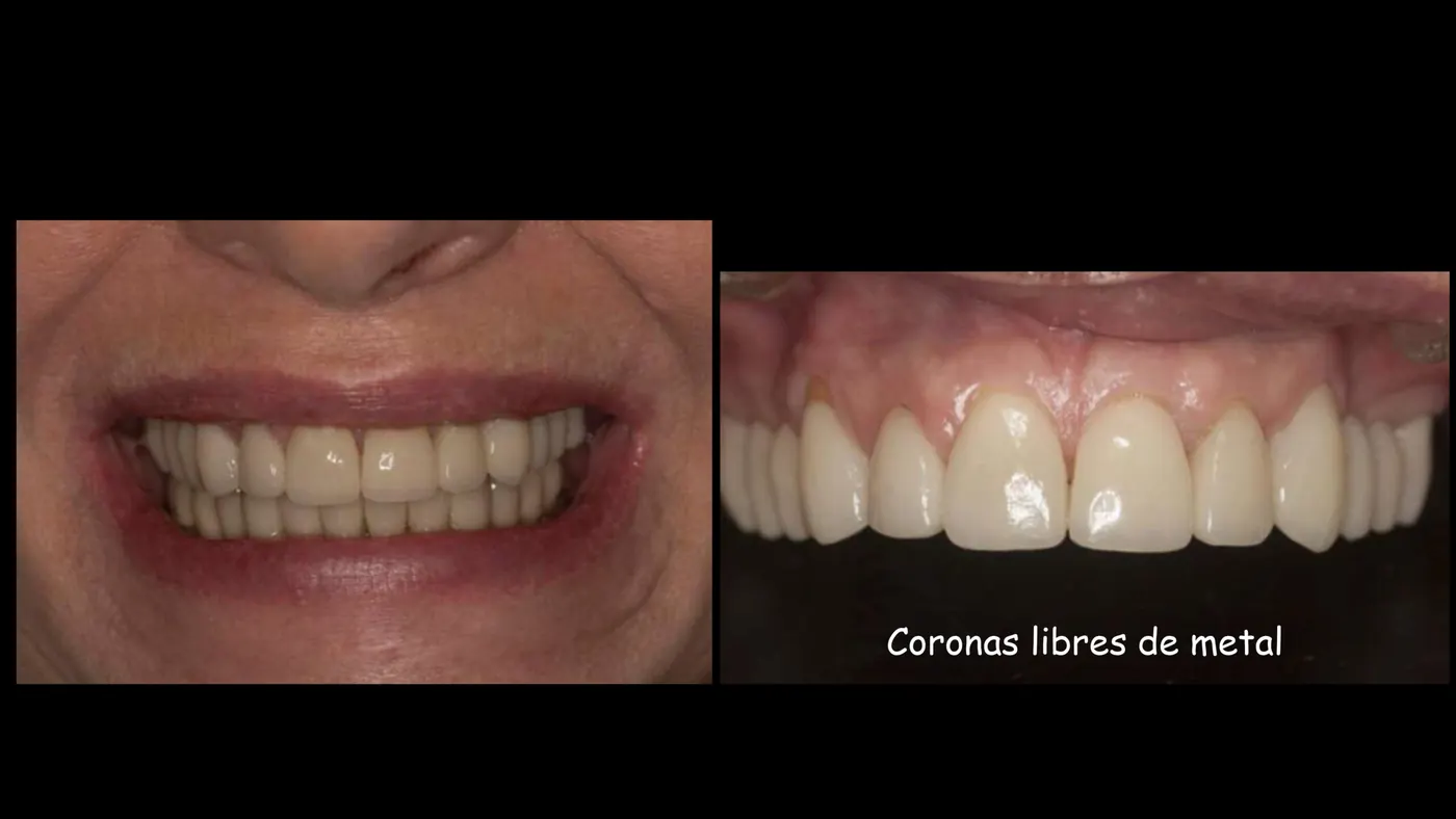 Sonrisa con coronas libres de metal sobre implantes