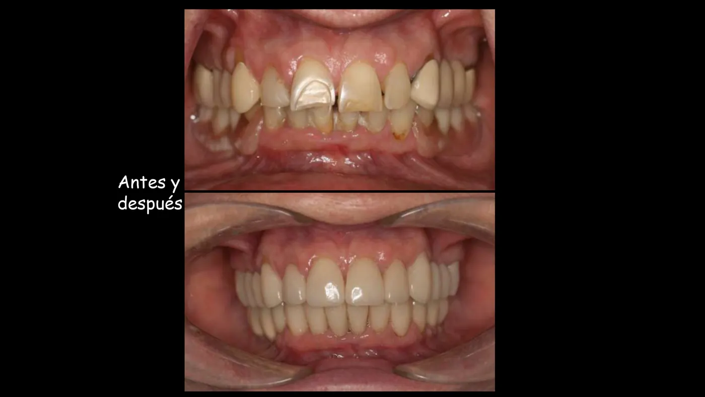 Antes y después de una rehabilitación sobre implantes