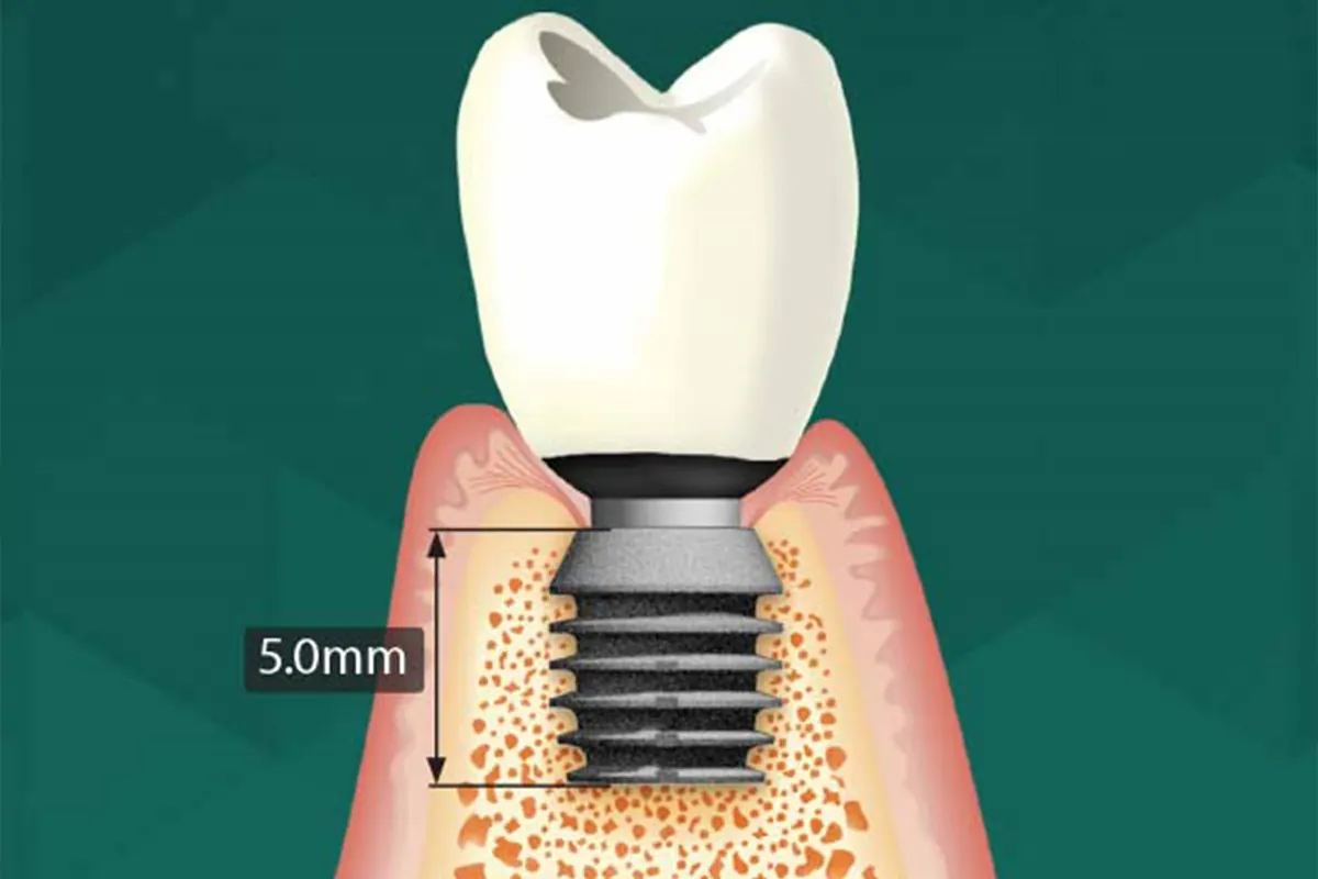 Implante corto Bicon de 5 mm con corona