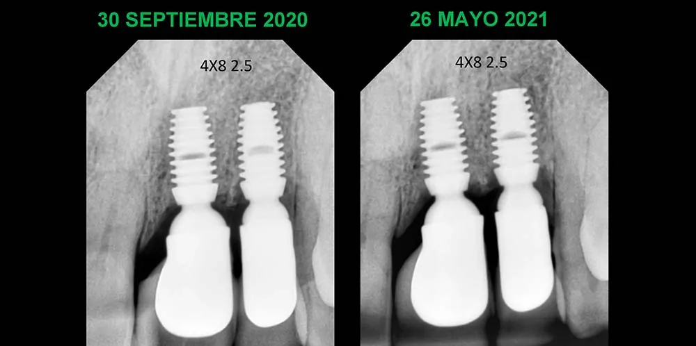 Seguimiento radiográfico de implante Bicon, caso 7