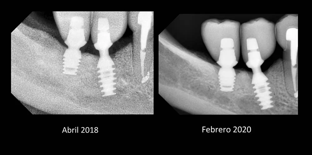 Seguimiento radiográfico de implante Bicon, caso 10