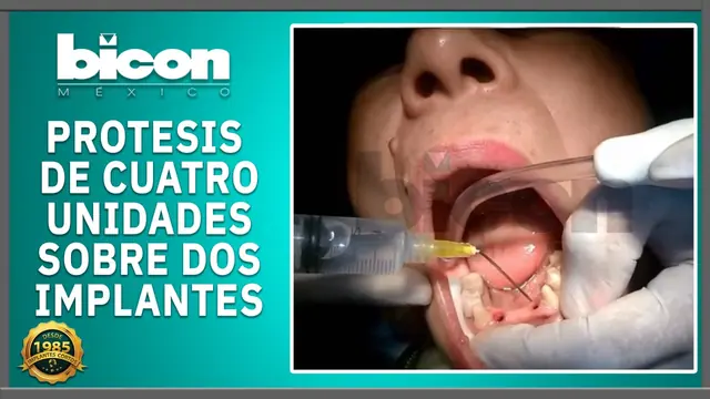 Prótesis de cuatro unidades sobre dos implantes