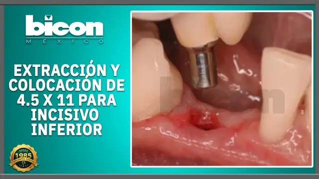 Extracción y colocación de 4.5 x 11 para incisivo inferior