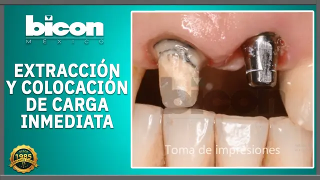 Extracción y colocación de carga inmediata