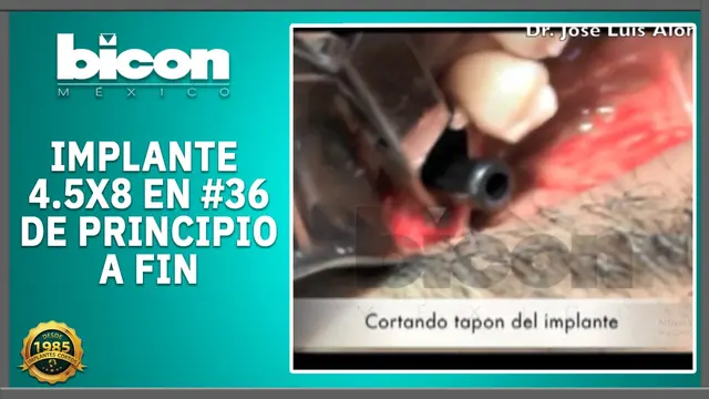 Implante 4.5 x 8 en #36 de principio a fin